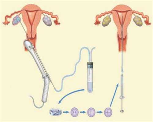 子宫内膜息肉手术多久可以做试管怀孕了呢